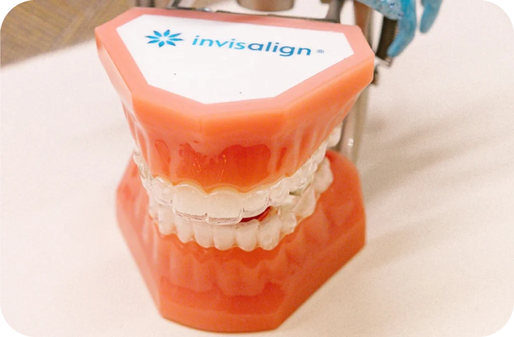 Aligneurs invisibles et orthodontie linguale