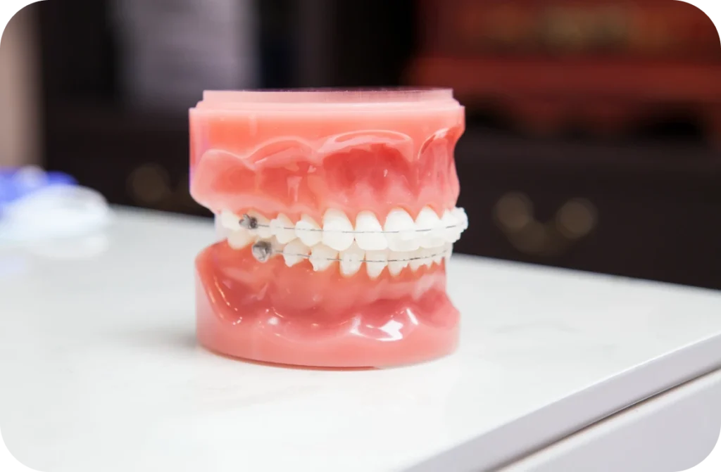 Appareils auto-ligaturants