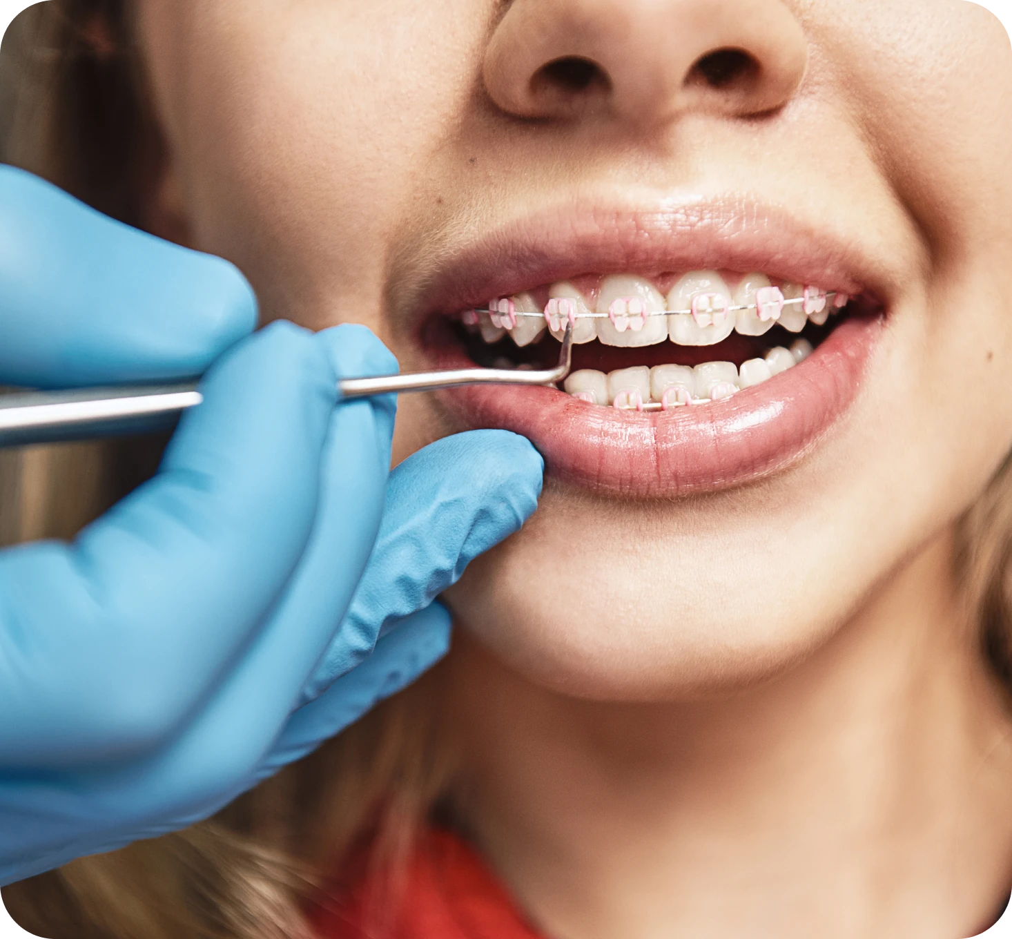 Appareils dentaires esthétiques