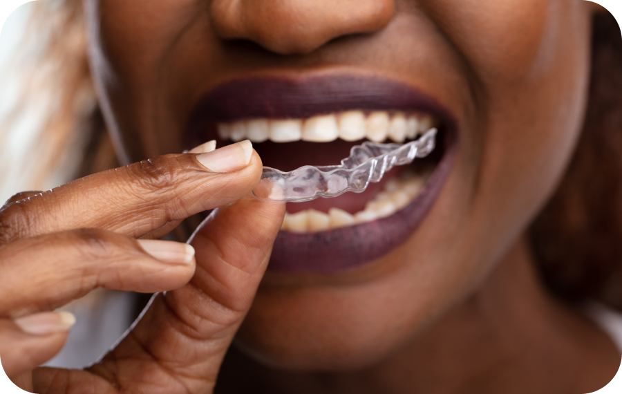 Invisalign à Monaco